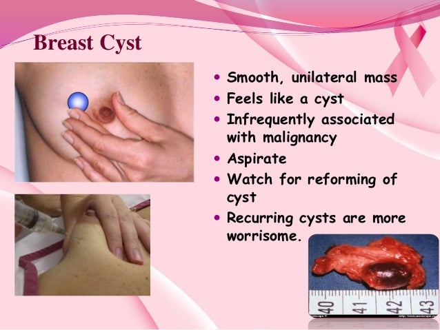 what causes cyst on breast What causes cyst on breast